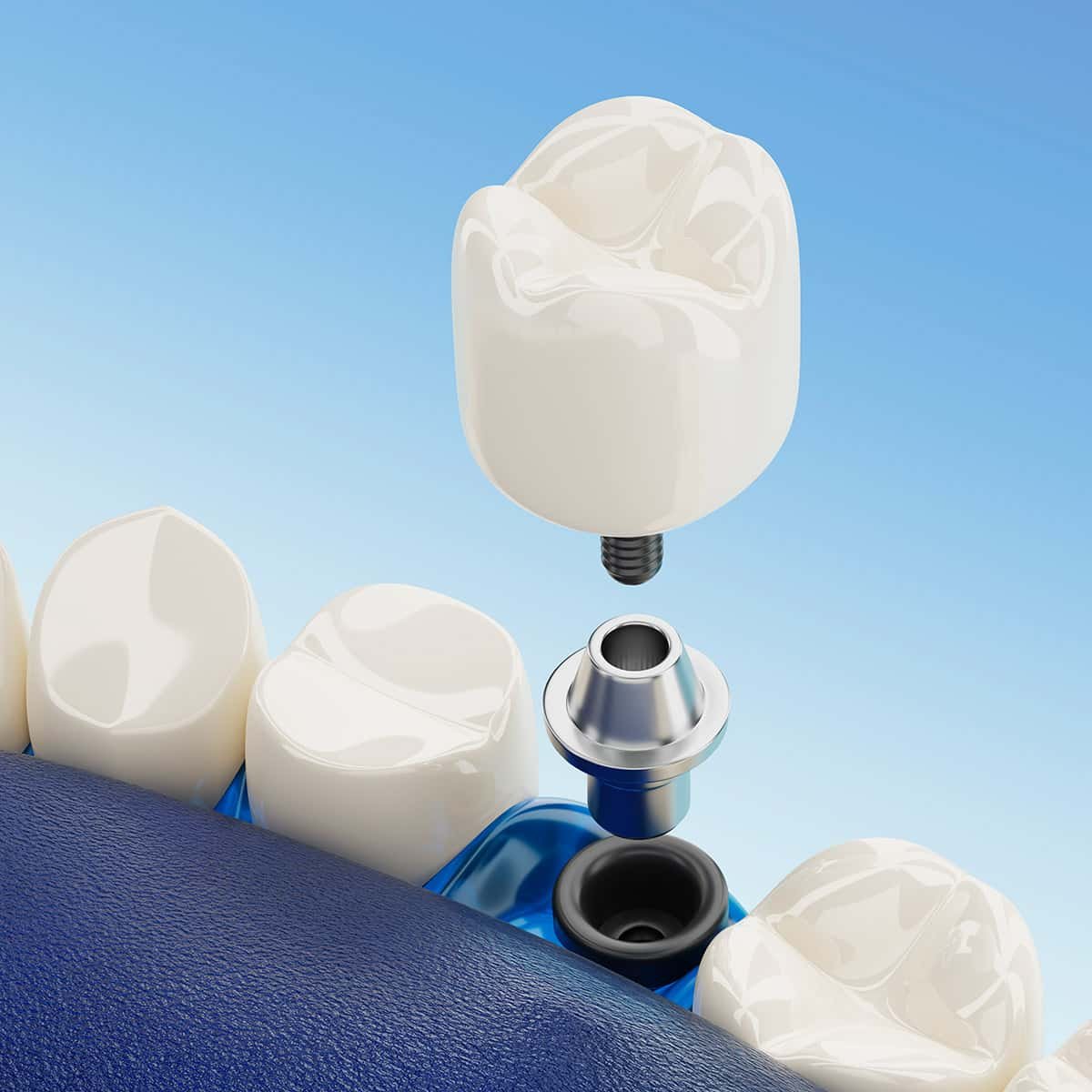 implant01 implant01